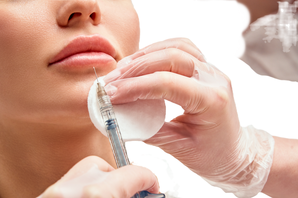 Revanesse Lips+ lip filler results at Elevate Health & Aesthetics